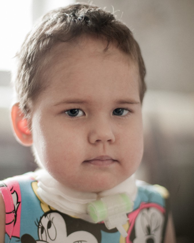 Фильтры для трахеостомы помогут Василисе дышать